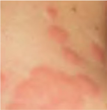 What do bed bug bites look like